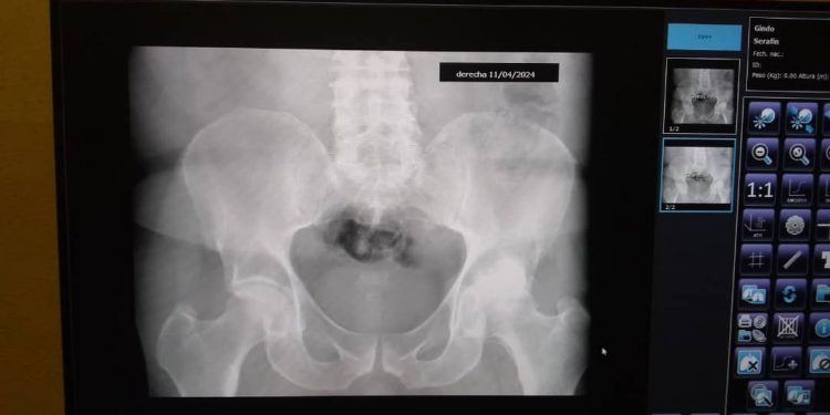 Recibe Artemisa digitalizadores de equipos de Rayos X